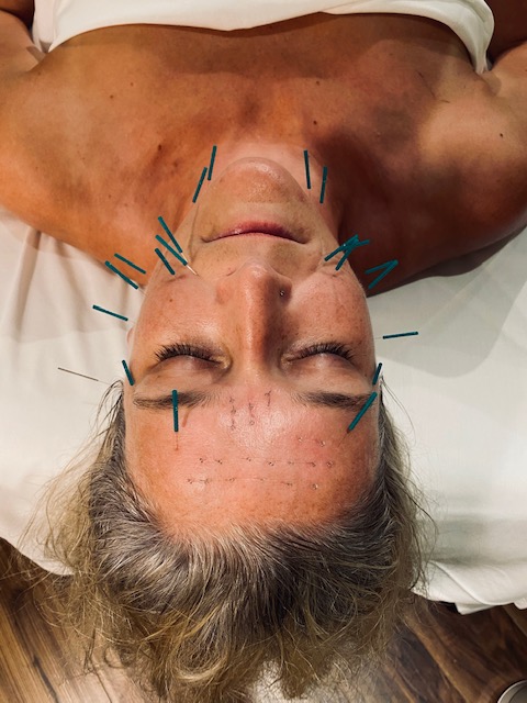 facial Rejuvenation acupuncture in progress