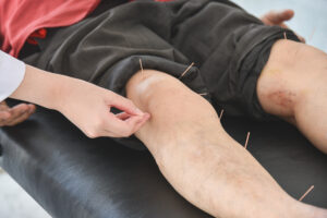 A man recieving acupuncture at knee and legs for relief pain ,Alternative medicine concept.