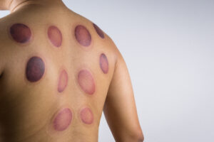 A man back with blood marks massaged after taking Chinese cupping therapy