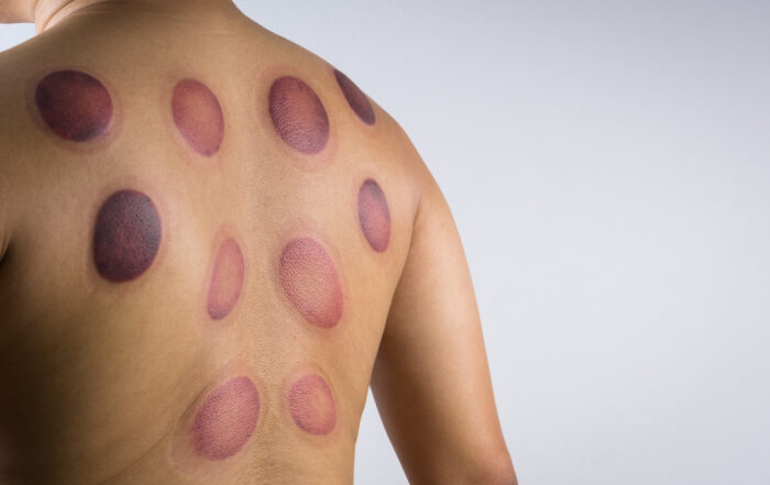 A man back with blood marks massaged after taking Chinese cupping therapy